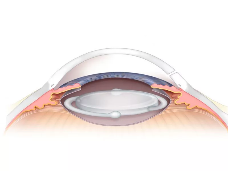 Иол в офтальмологии. Катаракта глаза анатомия. Анатомия хрусталика офтальмология. Катаракта строение глаза. Глазной хрусталик анатомия глаза.