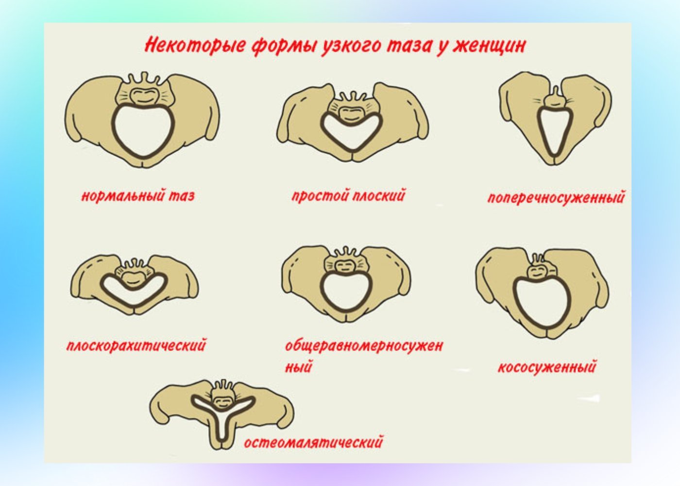 Роды 5 букв. Формы сужения таза Акушерство. Классификация узкого таза Акушерство. Суженный таз в акушерстве. Формы узкого таза в акушерстве.