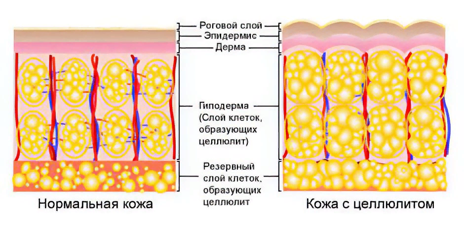 Фиброзные жировые изменения. Целлюлит строение. Нормальная кожа и кожа с целлюлитом. Целлюлит жировые клетки.