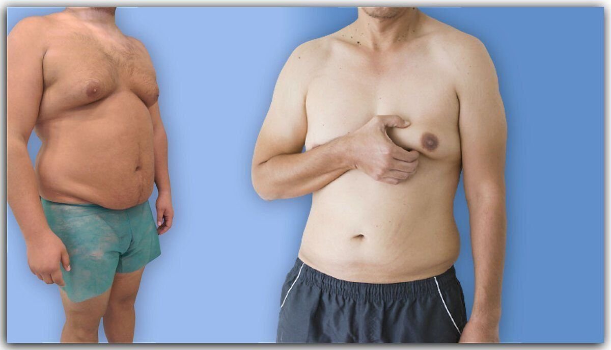 Почему у мужчин большие груди. Гинекомастия и липомастия.