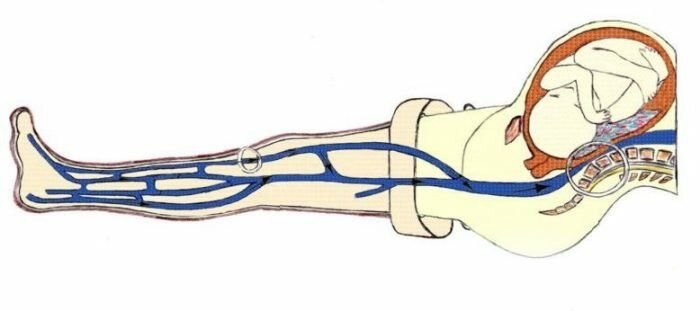 Вены беременность. Нижняя полая Вена при беременности. Синдром сдавления нижней полой вены. Нижняя полая Вена при беременности сдавление. Синдром аорто кавальной компрессии.