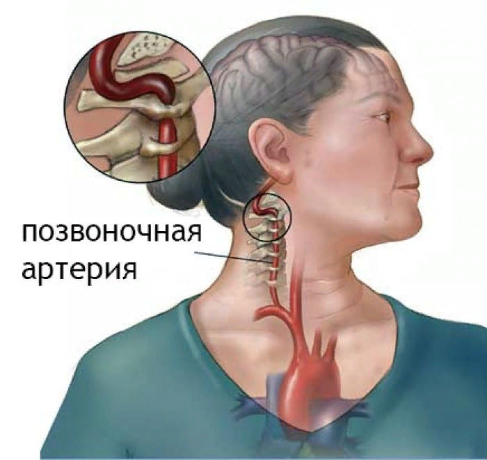 Звон в шее. Экстравазальная компрессия позвоночных артерий. Синдром позвоночной артерии клиника. Сдавление позвоночной артерии шейного отдела. Синдром позвоночной артерии снимок.