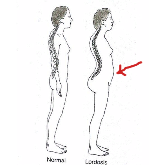 Лордоз поясничного отдела фото у женщин