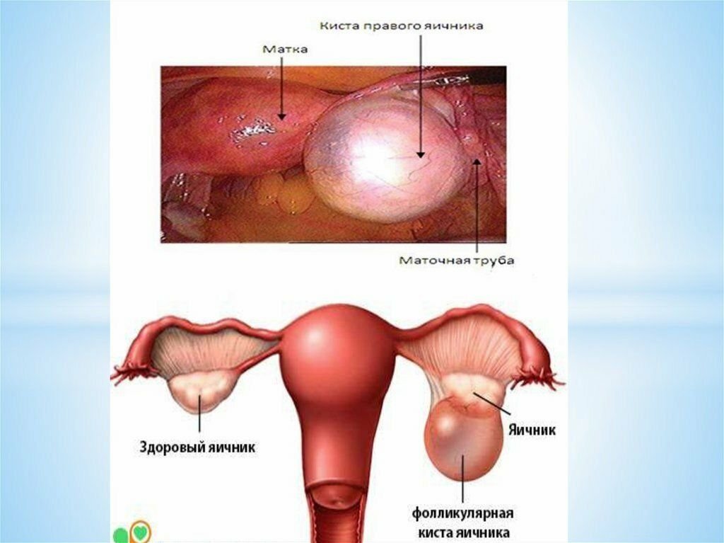 Как лечить кисту. Фолликулярная киста яичника. Фолликулярная киста яичн. Фолликулярные кисты яичников. Фолликулярная киста левого яичника.