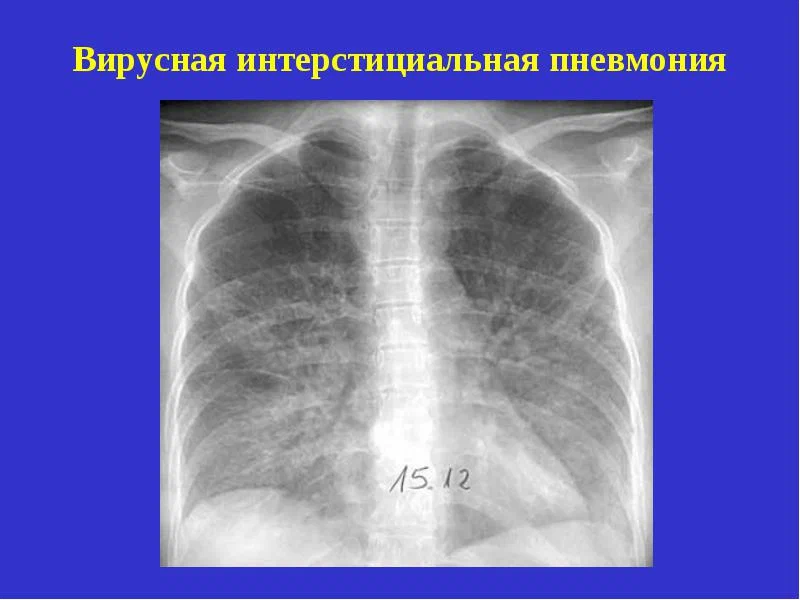 Картина двусторонней полисегментарной интерстициальной пневмонии