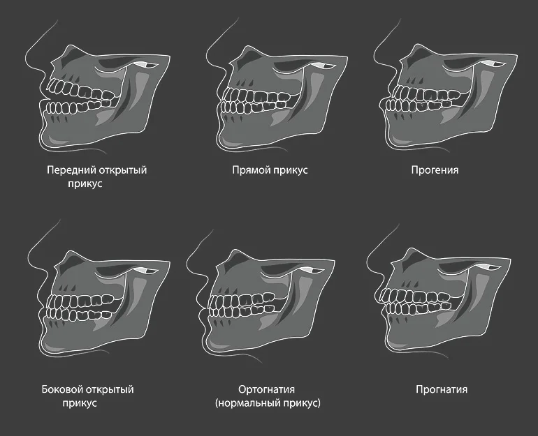 Перекус зубы. Правильное расположение челюсти сбоку. Форма нижней челюсти сбоку. Правильный прикус у человека схема сбоку.