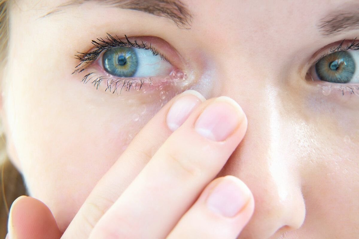 Аллергические заболевания глаз