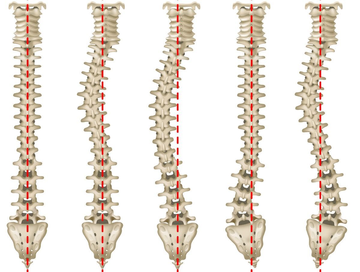 Что такое сколиоз. Сколиоз грудного отдела позвоночника 1ст. S образный грудопоясничный сколиоз 1 степени. Сколиоз 2 степени поясничного отдела. Сколиоз грудного отдела позвоночника 1 степени.