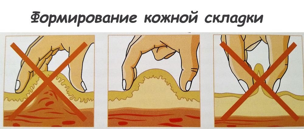 Места для укола инсулина картинки