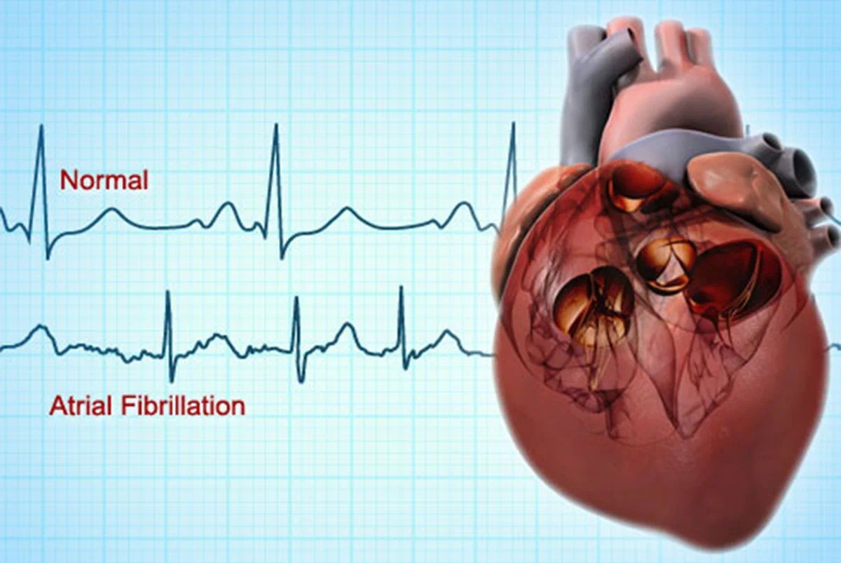 Atrial Fibrillation ЭКГ