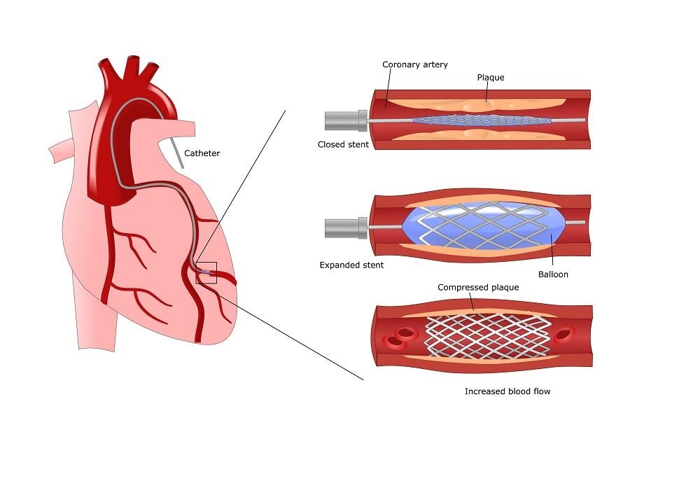 Как выглядит стент в сердце фото