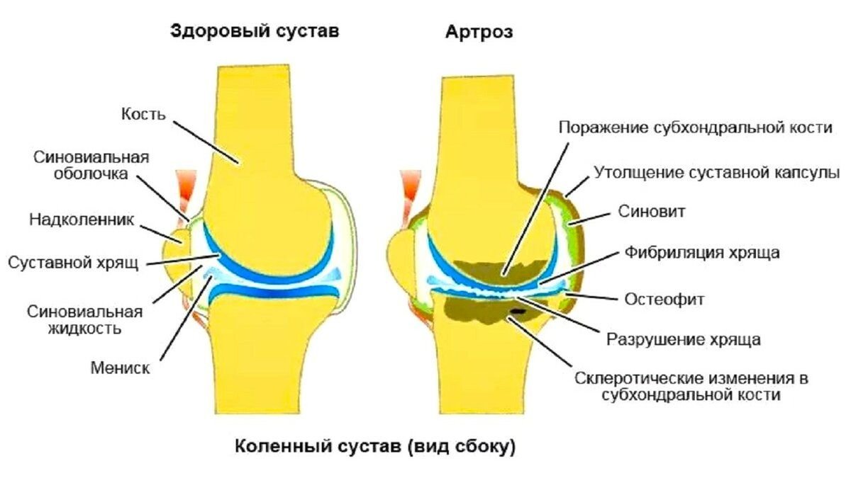 Жидкость в коленном суставе картинки