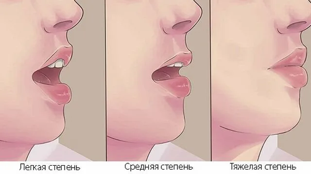 Лица не раскрывать. Тризм жевательных мышц нижней челюсти. Контрактура жевательных мышц. Тризм – спазм мышц челюстей.