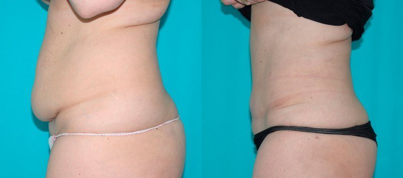 живот после кесарева до и после. пластика живота после кесарева. абдоминопластика зона. как убрать живот над швом. как убрать живот над швом.