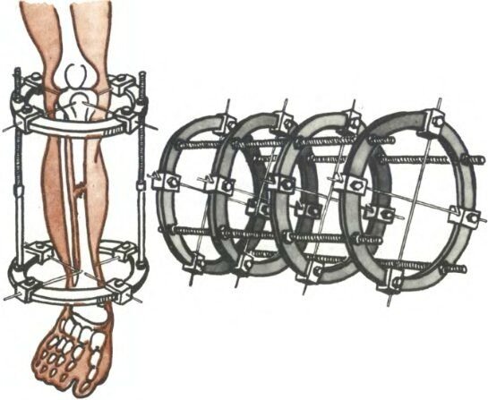 Аппарат илизарова картинки