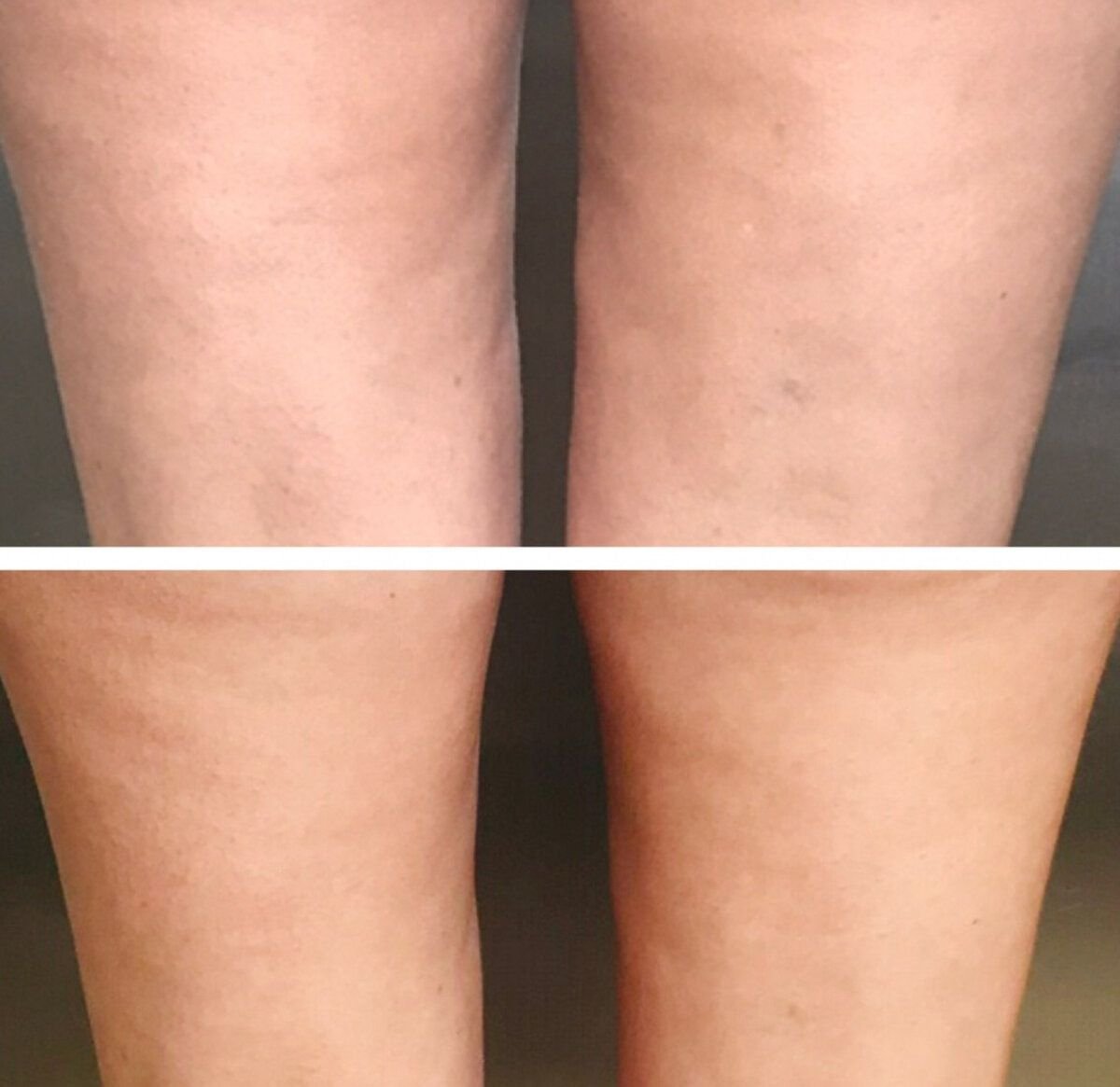 растяжка от целлюлита