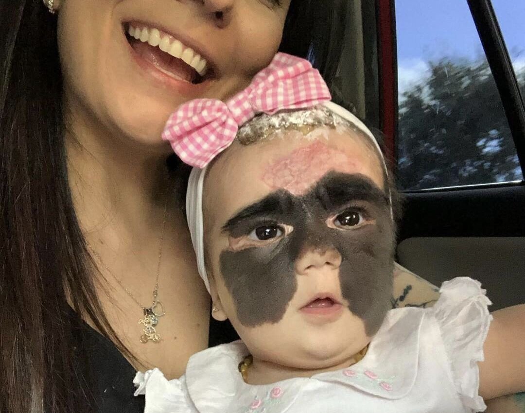 Девушка с родимым пятном на лице. Луна феннер после операции краснодар. Девочка с родимым пятном. Девушка с родимым пятном на лице. Девочка с родимым пятном.