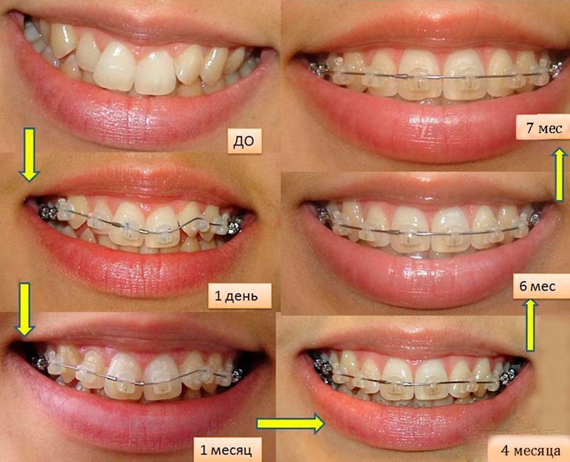Через сколько пройдет зуб. Безлигатурные брекеты h4. До и после ношения Брек тов. Ровные зубы после брекетов.