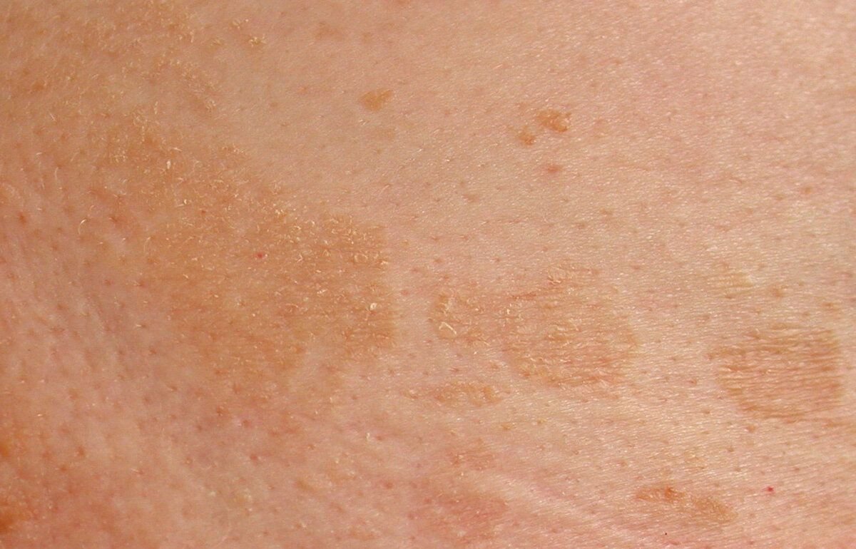 кожные заболевания груди у женщин фото 58