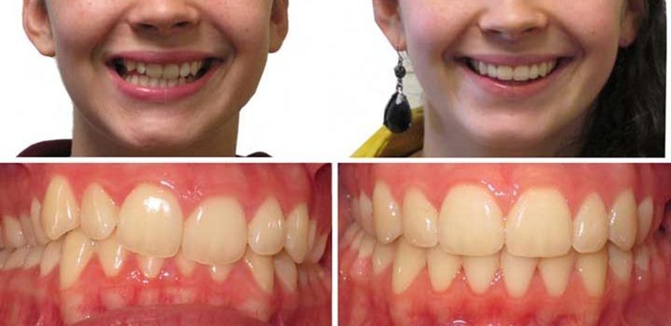 Брекеты до и после зубы прикус. Зубы после снятия брекетов. Исправление дистального прикуса. Дистальный прикус до и после брекетов. Исправление зубов брекетами.