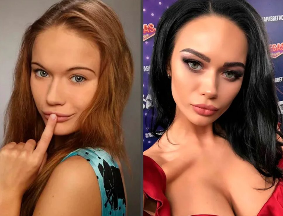 кошкина до операции и после