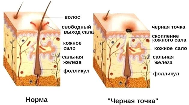 Как убрать чёрные точки на лице всего за 5 рублей. Заходите, научу.