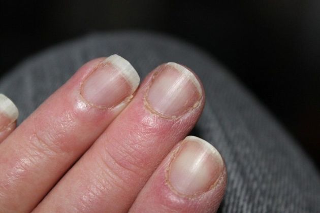 Сухая кутикула вокруг ногтей: 10 лайфхаков, как избавиться от сухой и грубой кожи вокруг ногтей