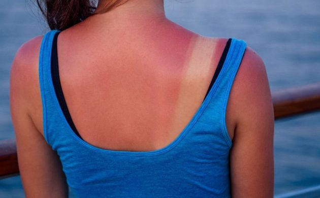 Обгоревшая кожа: 8 способов восстановить кожу после солнечного ожога