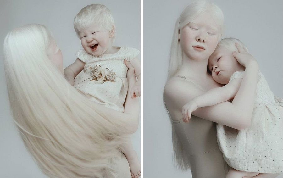 Как люди рождаются альбиносами. Сестры альбиносы из Казахстана. Близняшки альбиносы Казахстана.