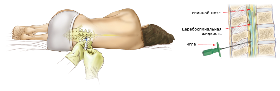 Эпидуральная спинная. Люмбальная пункция СМЖ. Спинально эпидуральная анестезия техника проведения. Эпидуральная анестезия спинной мозг. Каудальная эпидуральная блокада.