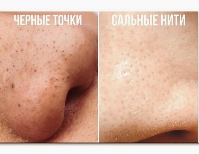 Не путайте черные точки с сальными нитями! В чем их разница и как от них избавиться | Лизи Визи | Пульс Mail.ru
