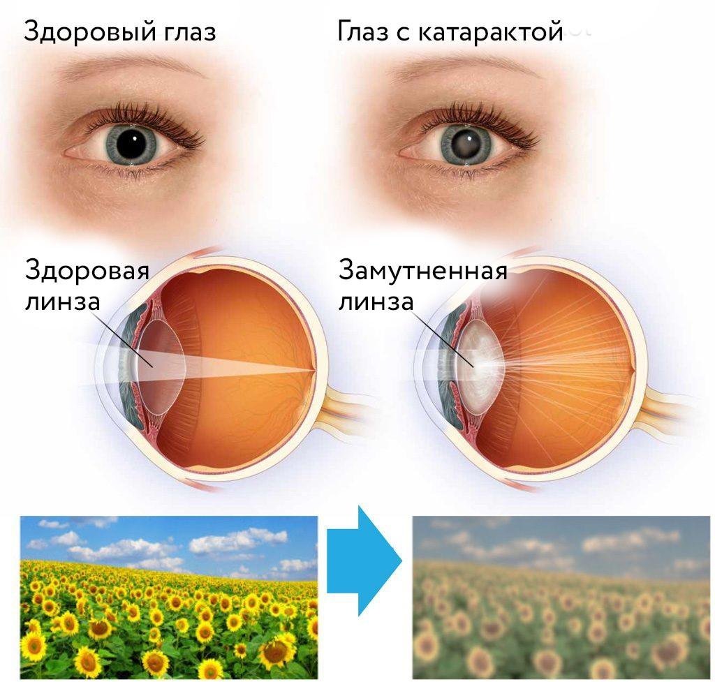 Почему человек видит прямое изображение. Катаракта – помутнение хрусталика глаза.. Здоровые глаза. Здоровый глаз и глаз с катарактой.