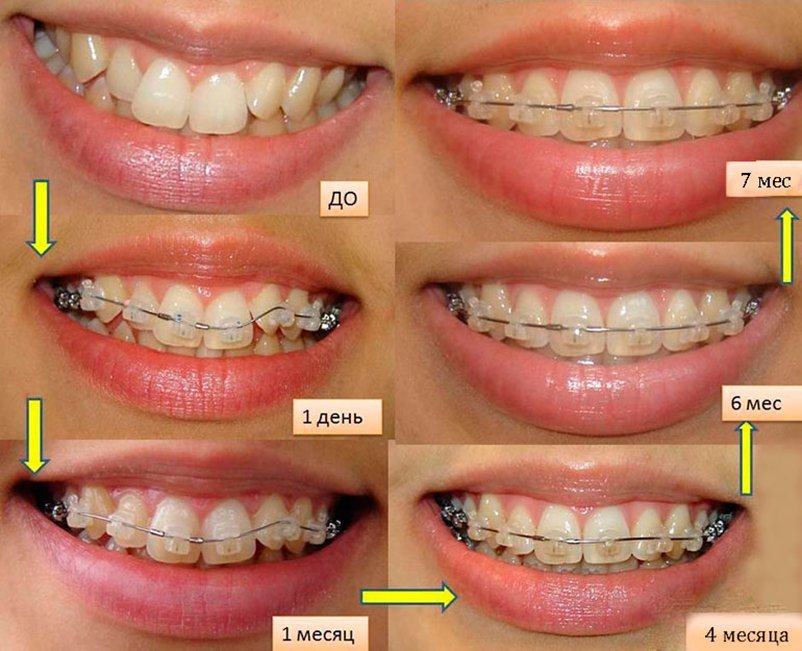 Меняются передние зубы